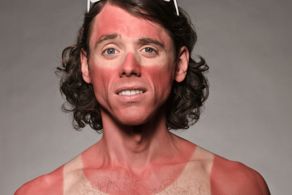 sunburned runner